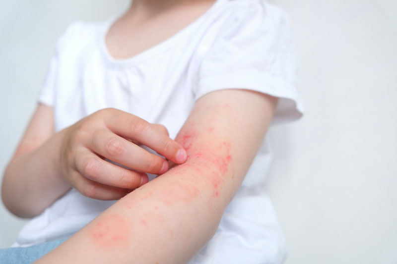 腕に湿疹が出ている子ども 